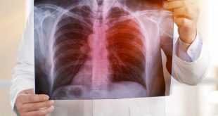Infectólogo afirma que el hacinamiento prolifera la tuberculosis